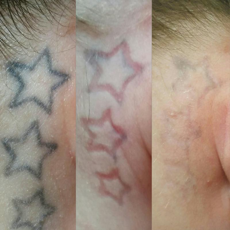 Tattoo Removal Certification